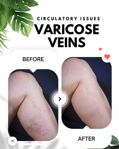 Varicose Veins Remedy Cream